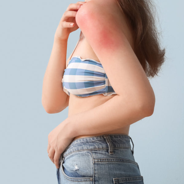Ideal for sunburn